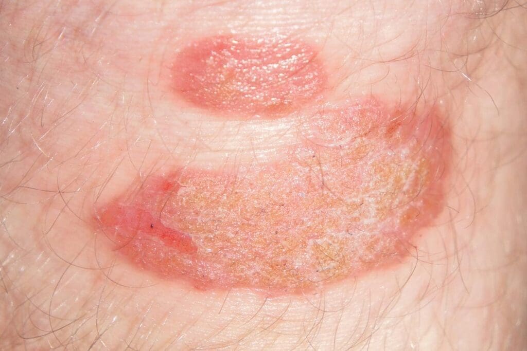 Psoriasis Skin Condition -Whipped Tallow Balm May Provide Some Relief for Your Skin